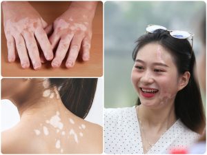 4 phương pháp điều trị bạch biến tốt nhất hiện nay