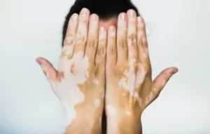 Hỏi đáp về bệnh bạch biến