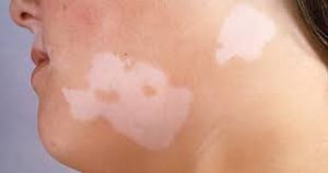 Chẩn đoán và điều trị bệnh bạch biến (Vitiligo)