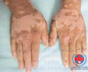 Cách điều trị bệnh bạch biến tận gốc vĩnh viễn