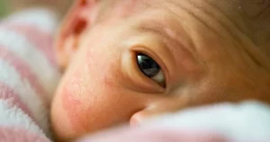 Nhận biết sớm dấu hiệu bệnh bạch biến ở trẻ sơ sinh