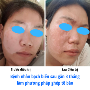 Ghép tế bào thượng bì tự thân không qua nuôi cấy điều trị bạch biến